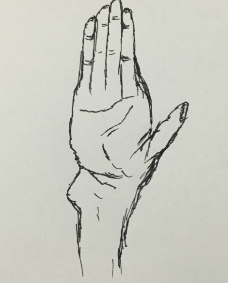 护理学基础知识:考点记忆梳理常见的四肢骨骨折